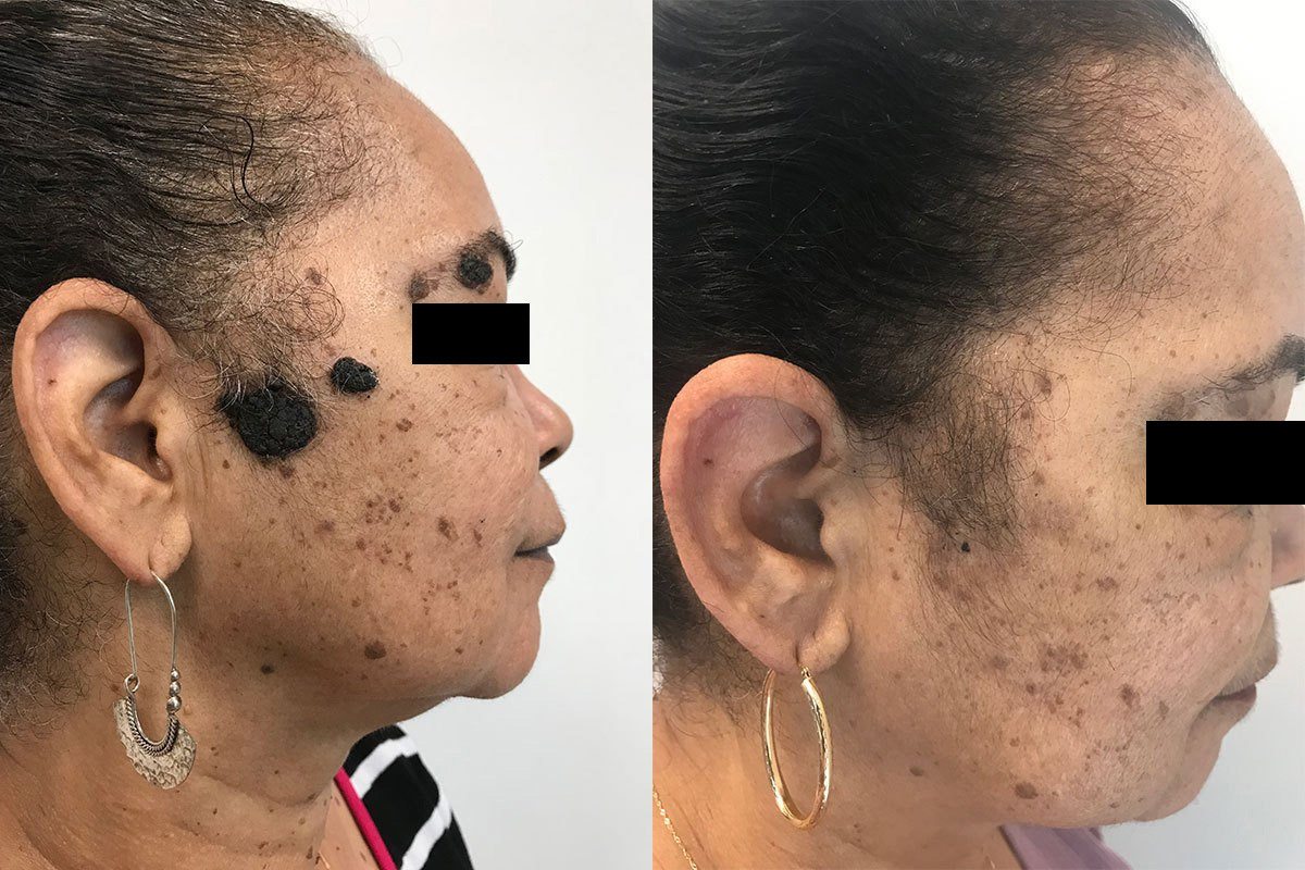 What Is Mole Removal?
