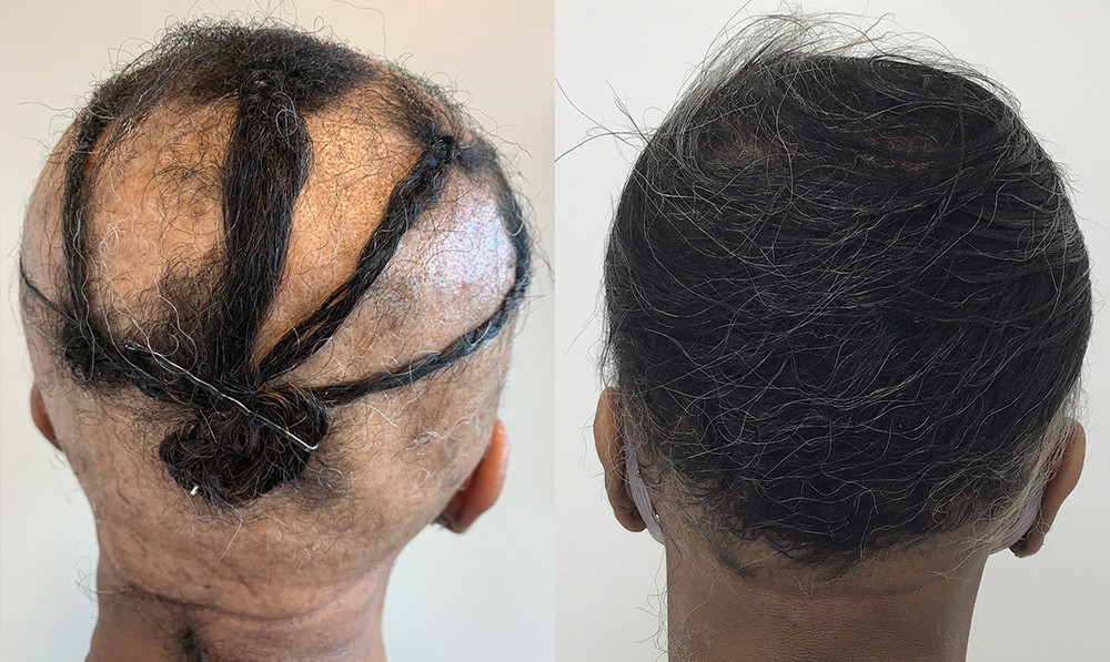 Hair Loss Specialist | Columbia MD | Dr. Ife Rodney - Eternal Dermatology