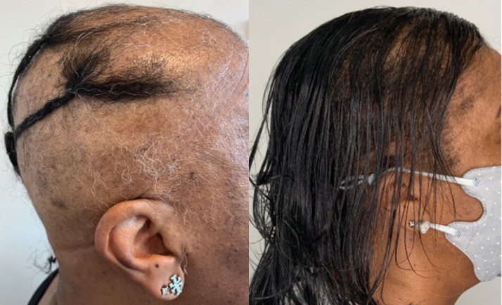 Hair Loss Specialist, Columbia MD| and Washington DC - Eternal Dermatology  Columbia MD