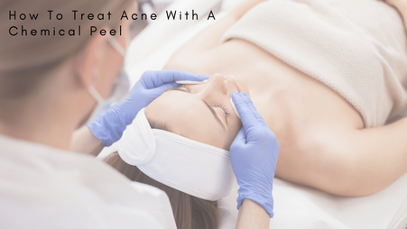 treat acne with a chemical peel