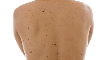 what are moles?