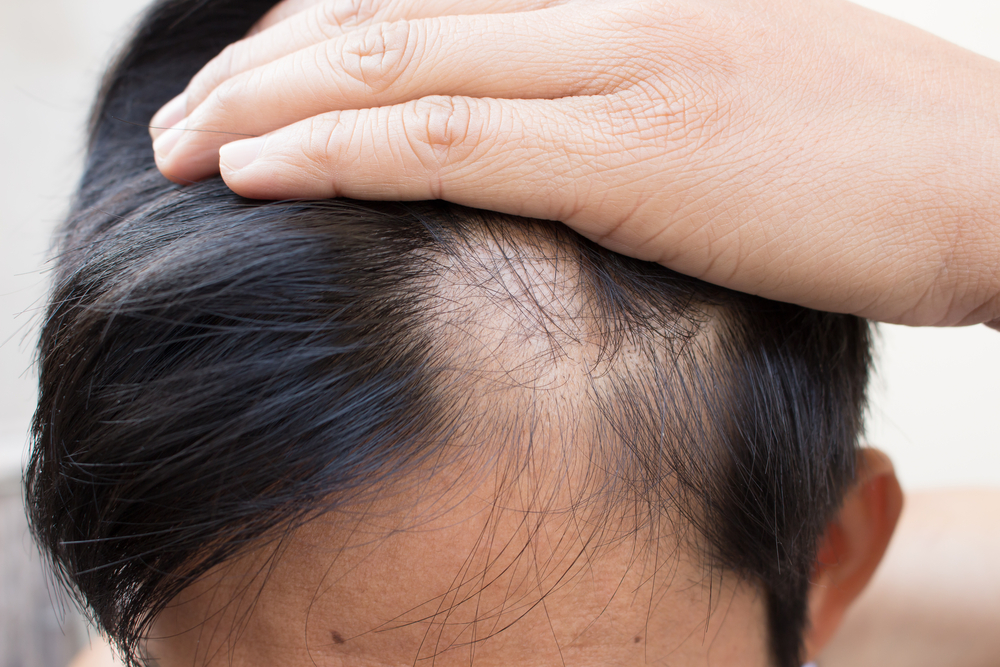 Minoxidil for Hair Loss - Eternal Dermatology Columbia MD