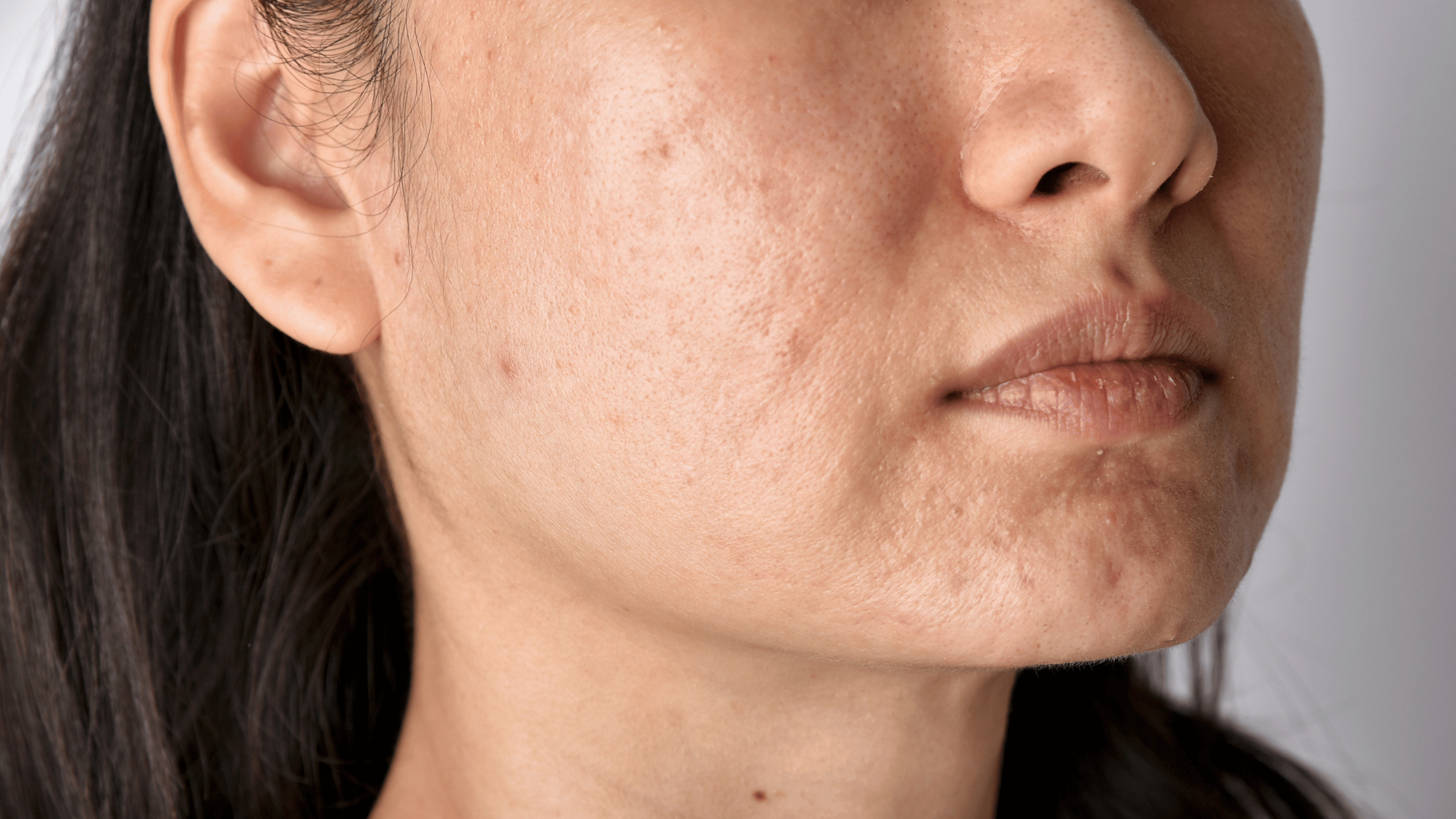 fraxel laser for acne scarring