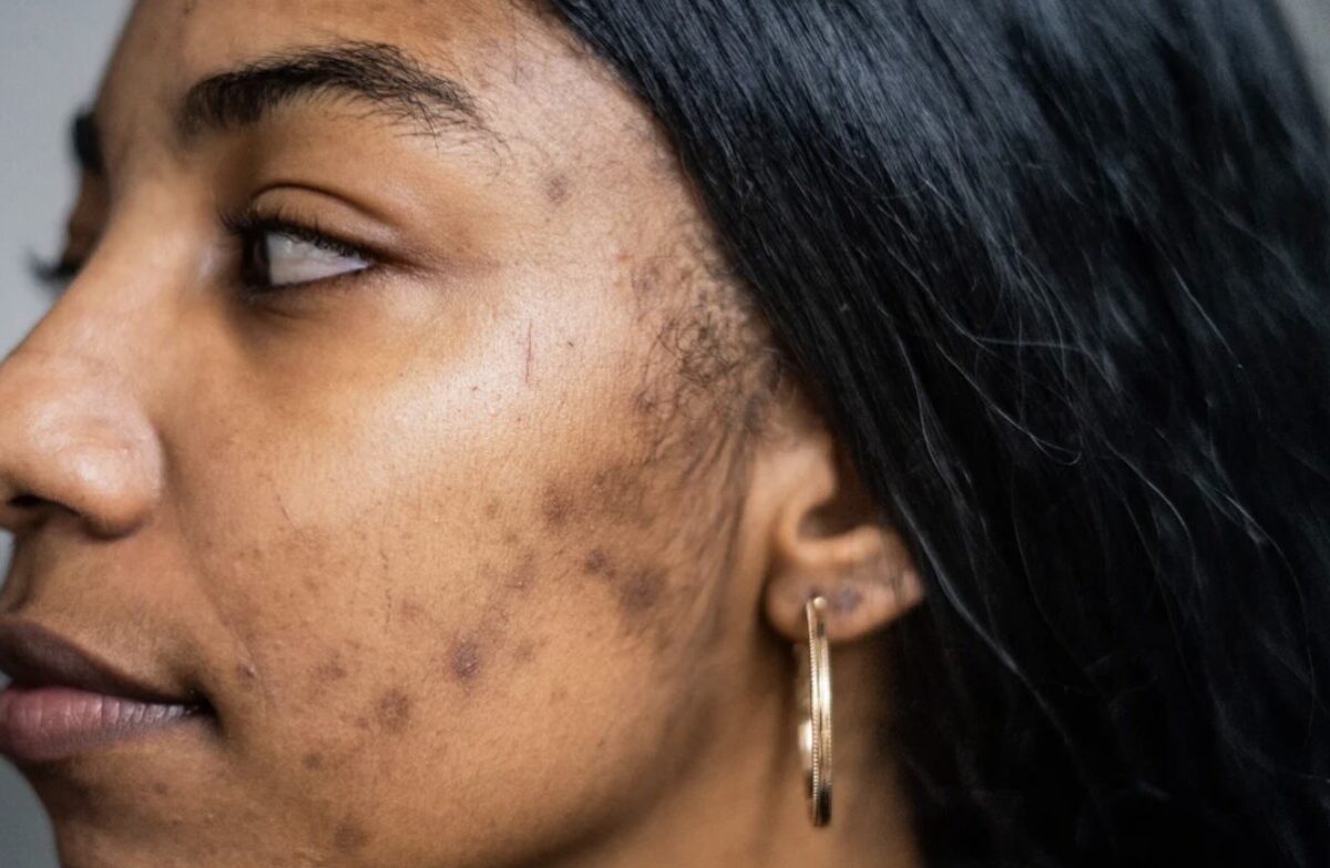 black woman with acne scarring