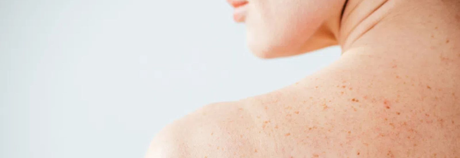Are Moles Cancerous? What Percentage Should You Worry About?