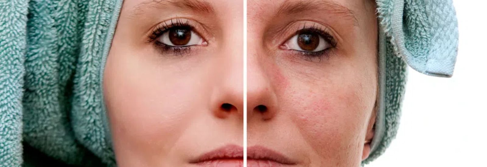 Woman after acne treatment